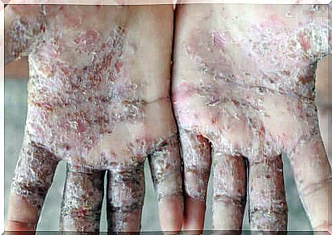 3 natural remedies for scabies