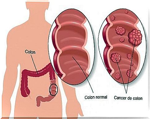 5 measures to prevent colon cancer