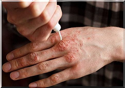 6 natural creams to relieve psoriasis