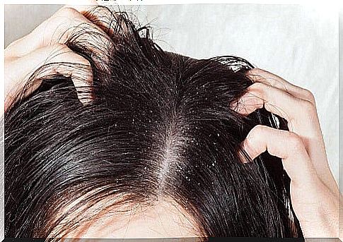 6 natural remedies for scalp mycoses