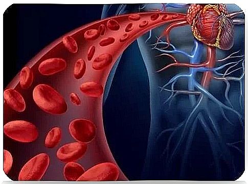 Abdominal aortic aneurysm