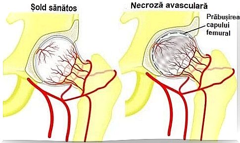 Avascular necrosis of the femoral head