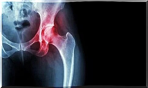 Avascular necrosis of the femoral head