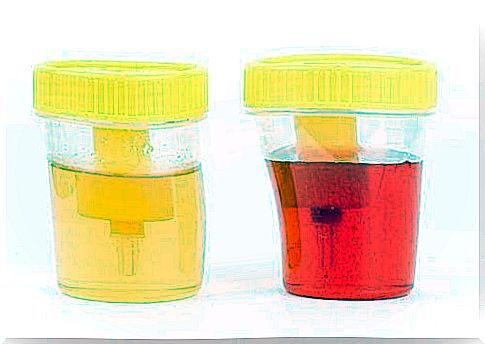 Blood in the urine: symptoms and causes of hematuria