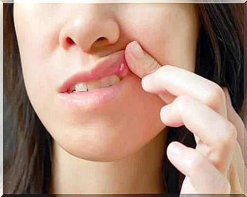 Causes and treatment of canker sores