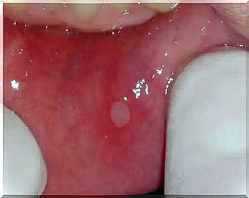 Oral thrush