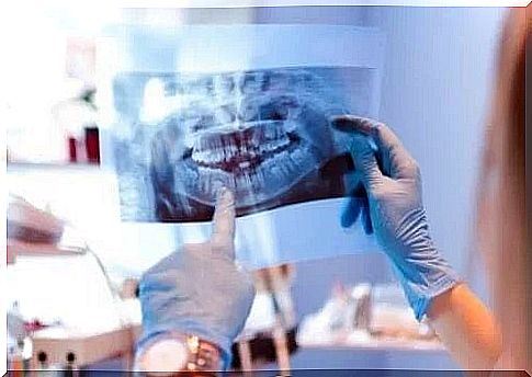 Causes of dislocation of the temporomandibular joint