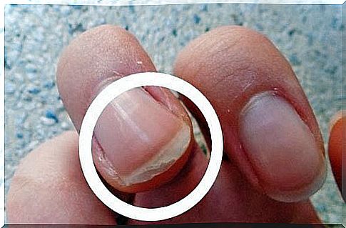 Causes, treatments and solutions for exfoliated nails