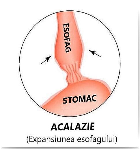 Deseun illustrating the damage caused by esophageal achalasia