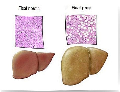 Fatty liver and its causes