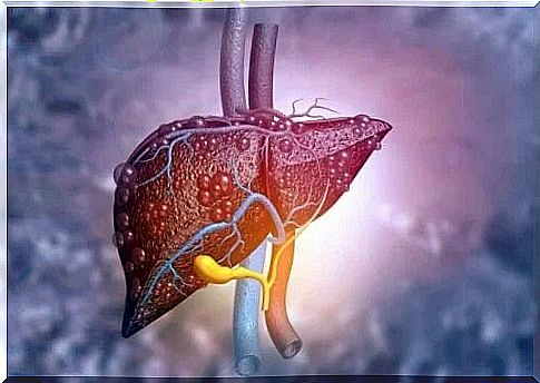 Liver affected by cirrhosis