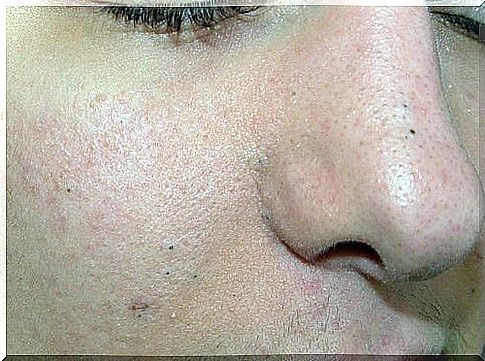 Get rid of blackheads with 4 natural masks