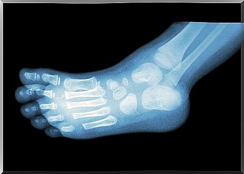 The following prevention methods help you avoid calcaneus spurs