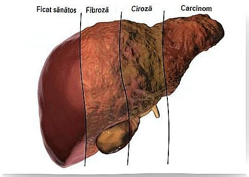 Liver metabolism leading to cirrhosis