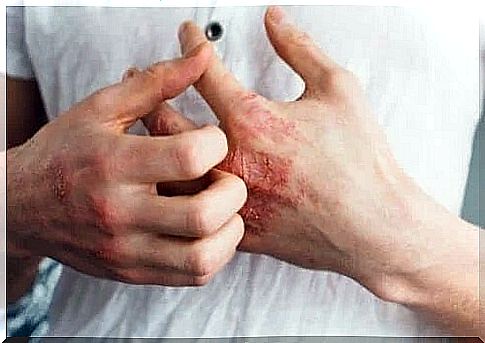 Person with psoriasis