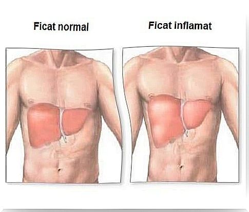 Inflammation of the liver - symptoms and remedies