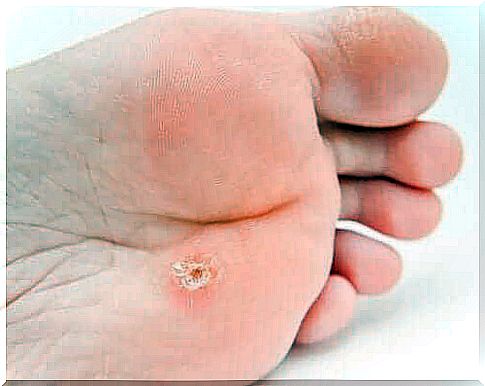 Plantar wart features and treatments available