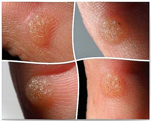 Isolated plantar wart features