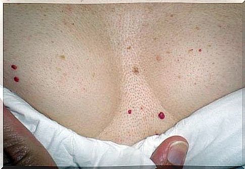 Red spots on the skin - when are they dangerous?