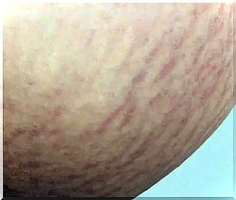 Remedies for white and red stretch marks