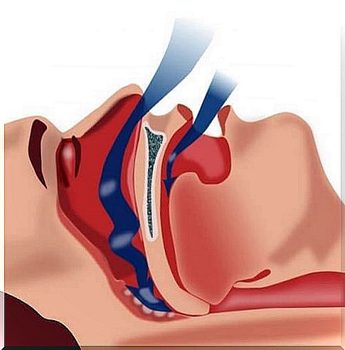 Treatments for sleep apnea