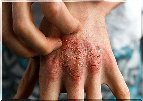 The main treatments for psoriasis