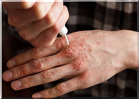 Topical psoriasis treatments