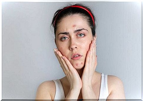 Woman with pimples on her face