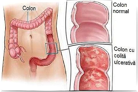 Ulcerative colitis causes ulcers in the colon