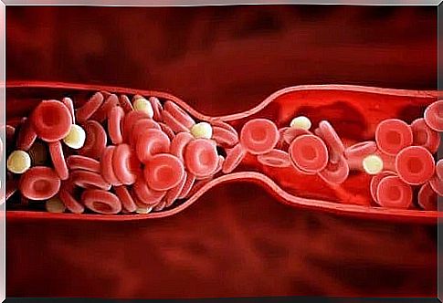 Narrowed blood vessel