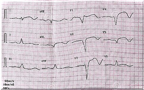 The results of an EKG